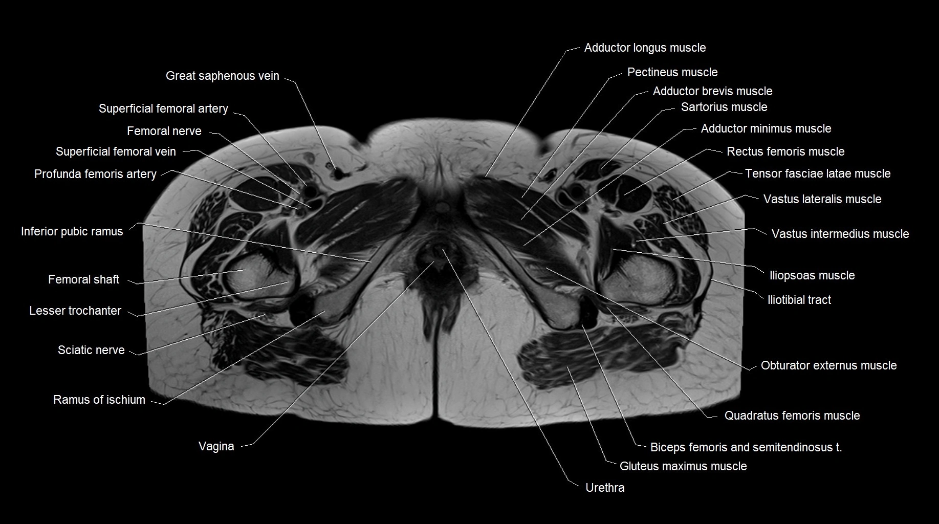 MRI 3T pelvis axial cross section anatomy image 31.webp